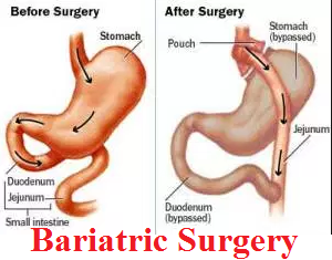 Bariatric Surgery Right for You