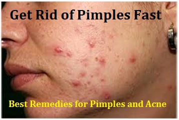 Get Rid of Pimples Fast